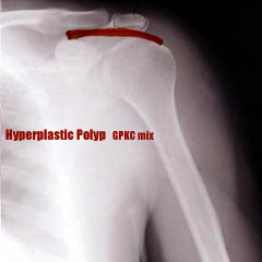 Hyperplastic Polyp -GPKC mix